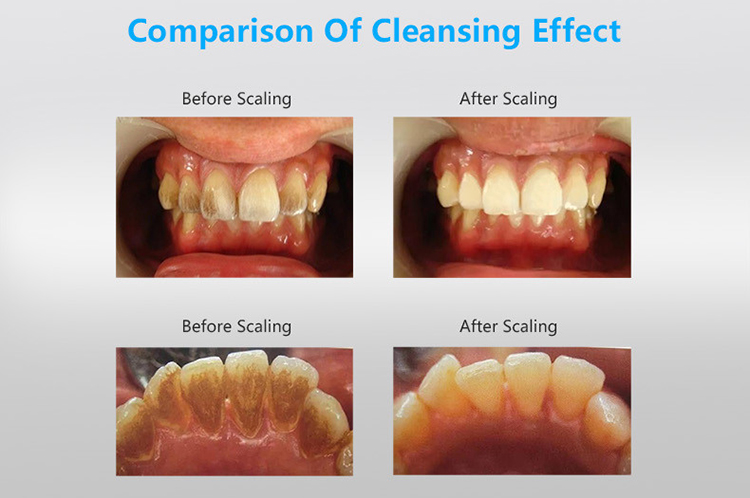 Periodontal Treatment Device